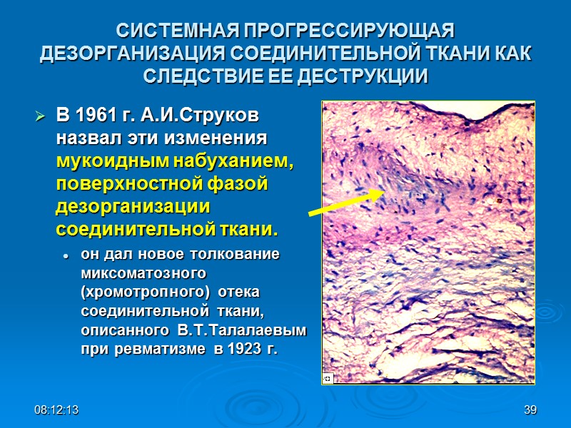 СИСТЕМНАЯ ПРОГРЕССИРУЮЩАЯ ДЕЗОРГАНИЗАЦИЯ СОЕДИНИТЕЛЬНОЙ ТКАНИ КАК СЛЕДСТВИЕ ЕЕ ДЕСТРУКЦИИ В 1961 г. А.И.Струков назвал